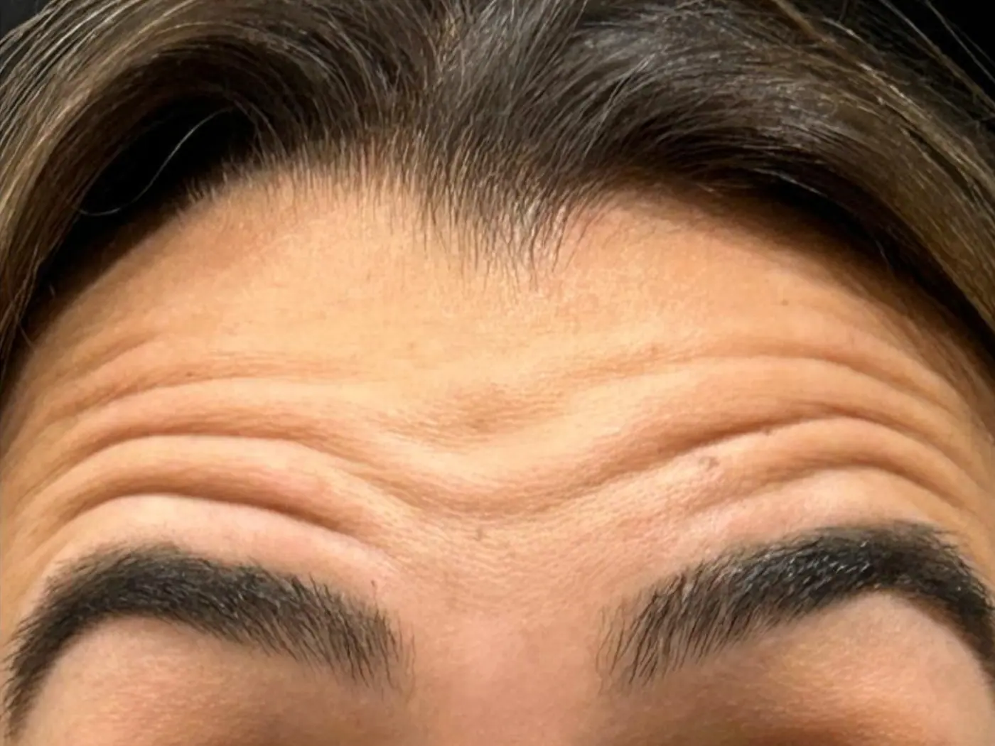 Antes - Botox (Toxina Botulínica)