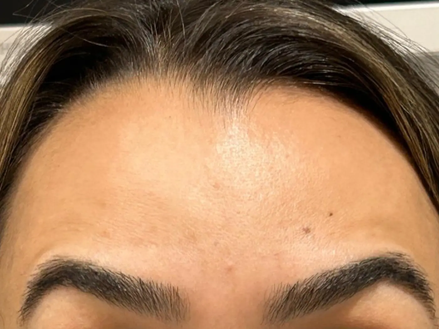Depois - Botox (Toxina Botulínica)
