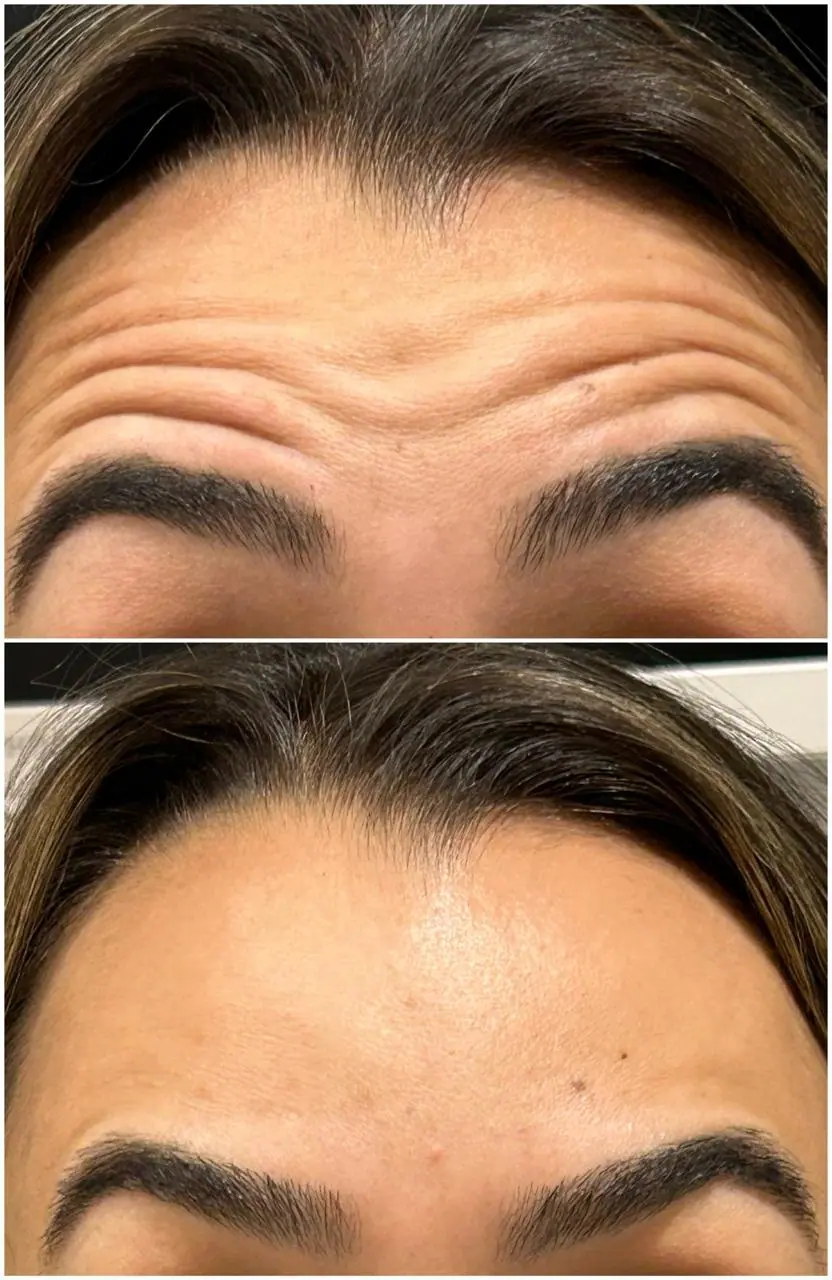 Botox - Linhas de Expressão