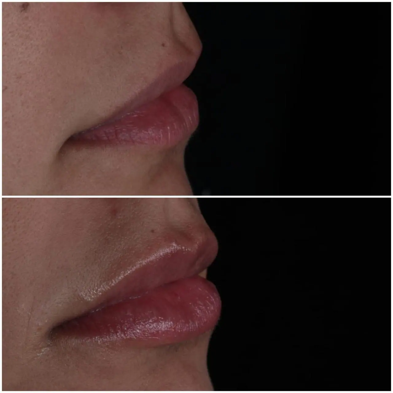 Preenchimento Labial