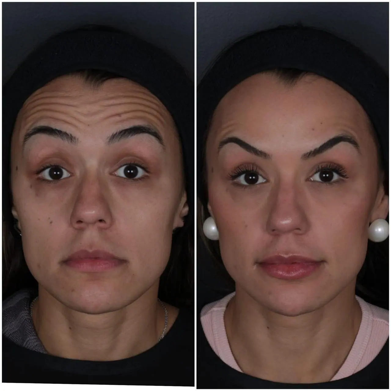 Botox - Linhas de Expressão
