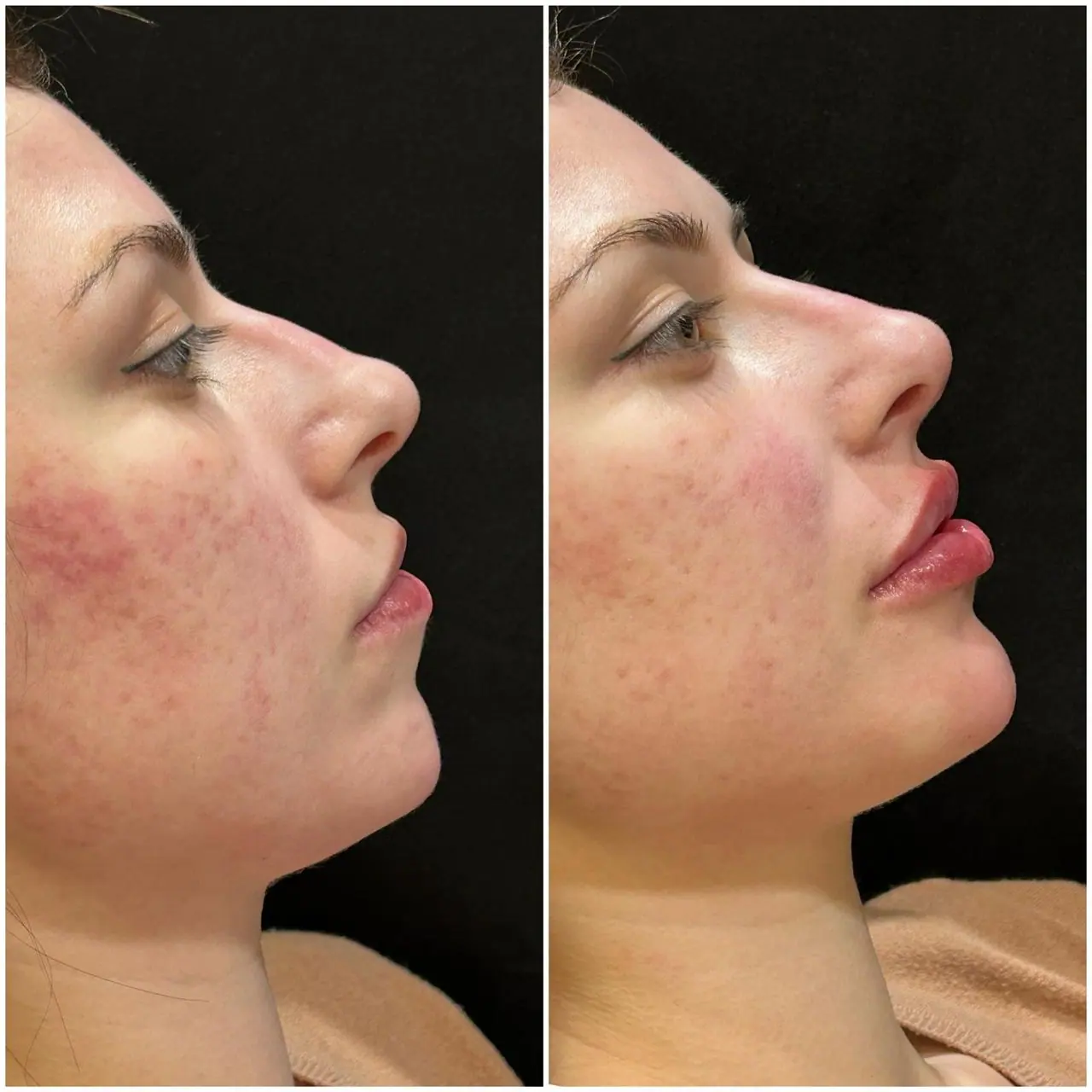 Preenchimento Labial