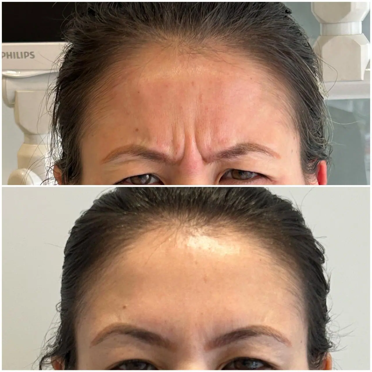 Botox - Linhas da Testa