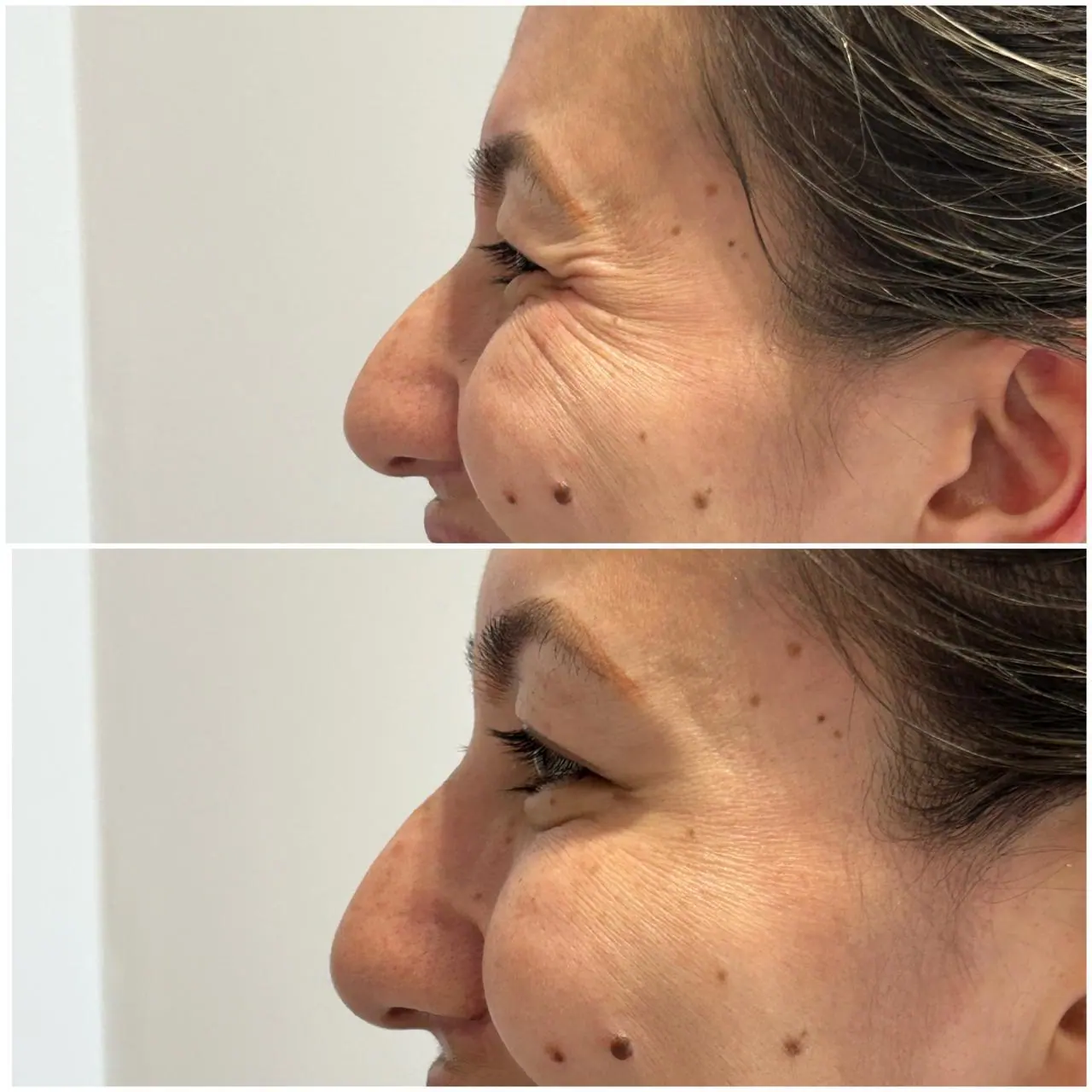 Botox - Pés de Galinha