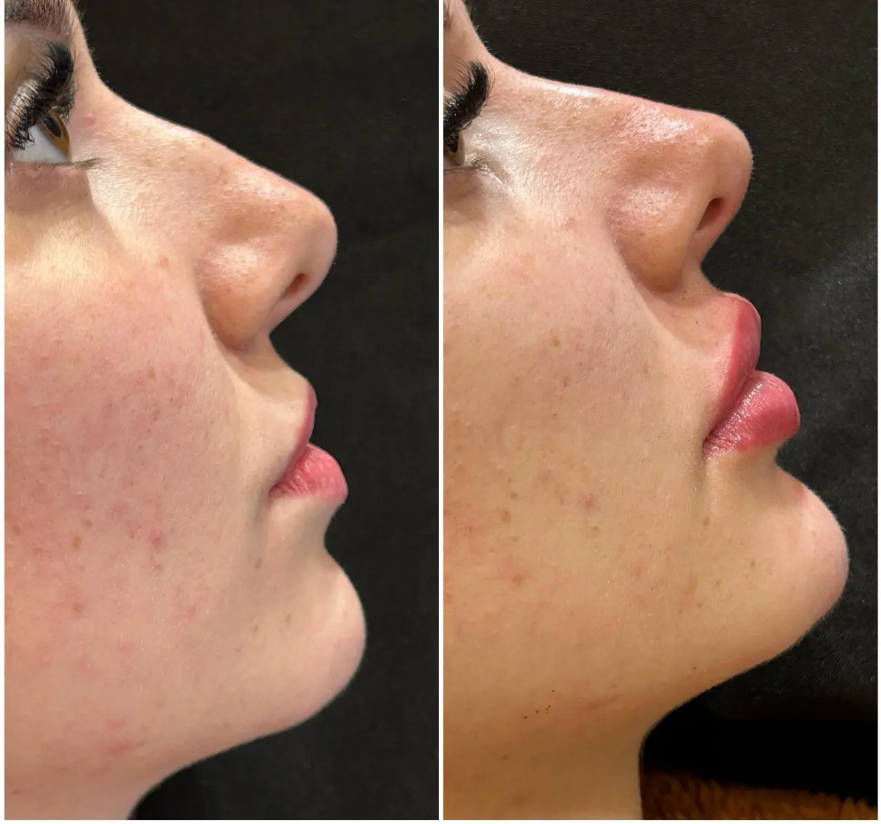 Preenchimento Labial