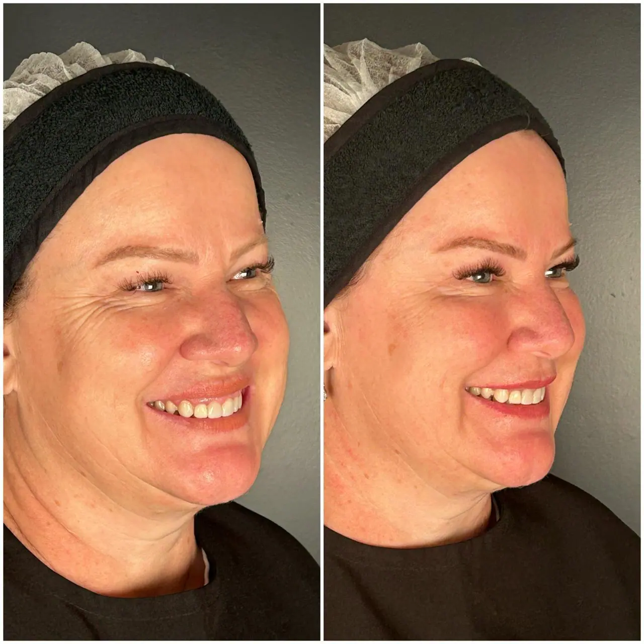 Harmonização Facial Completa