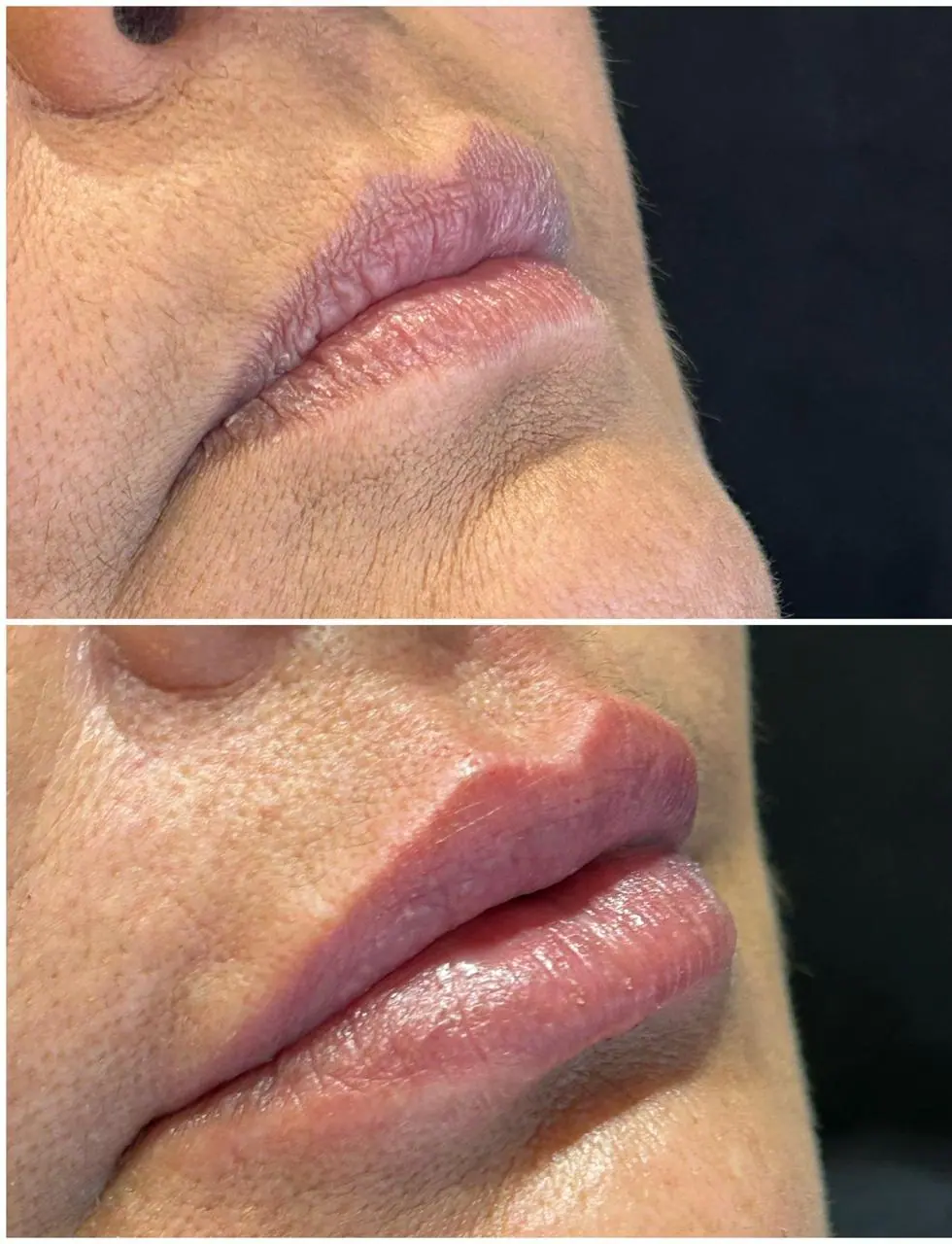 Preenchimento Labial