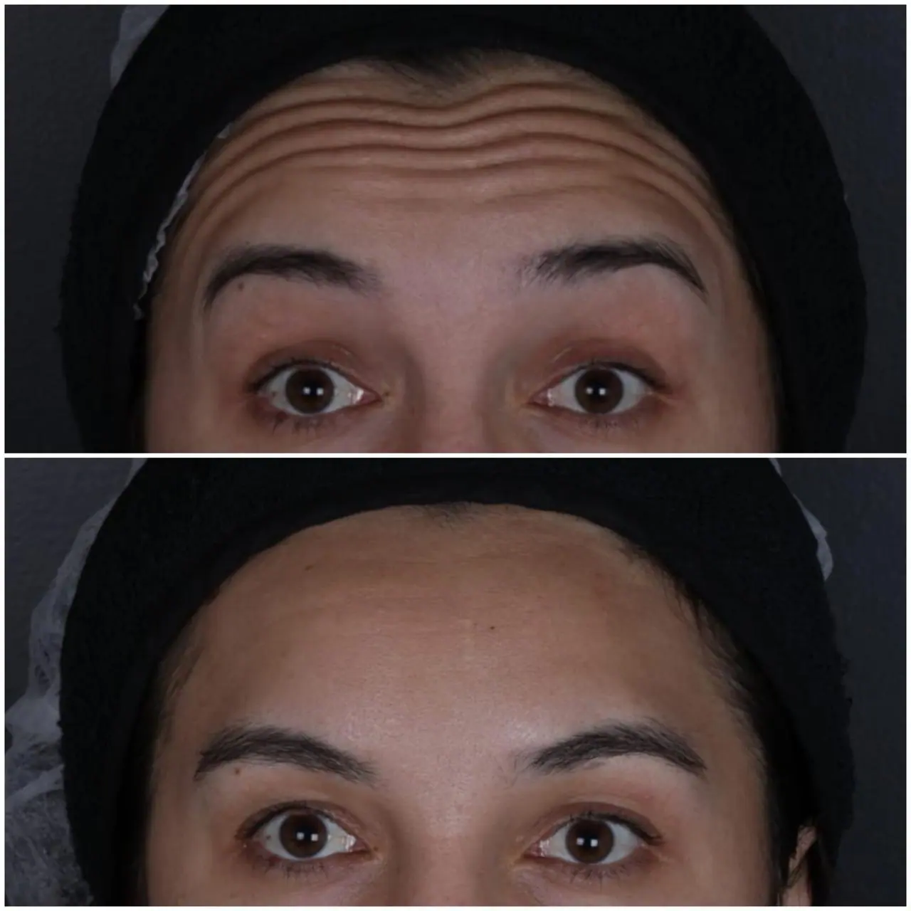Botox - Linhas da Testa