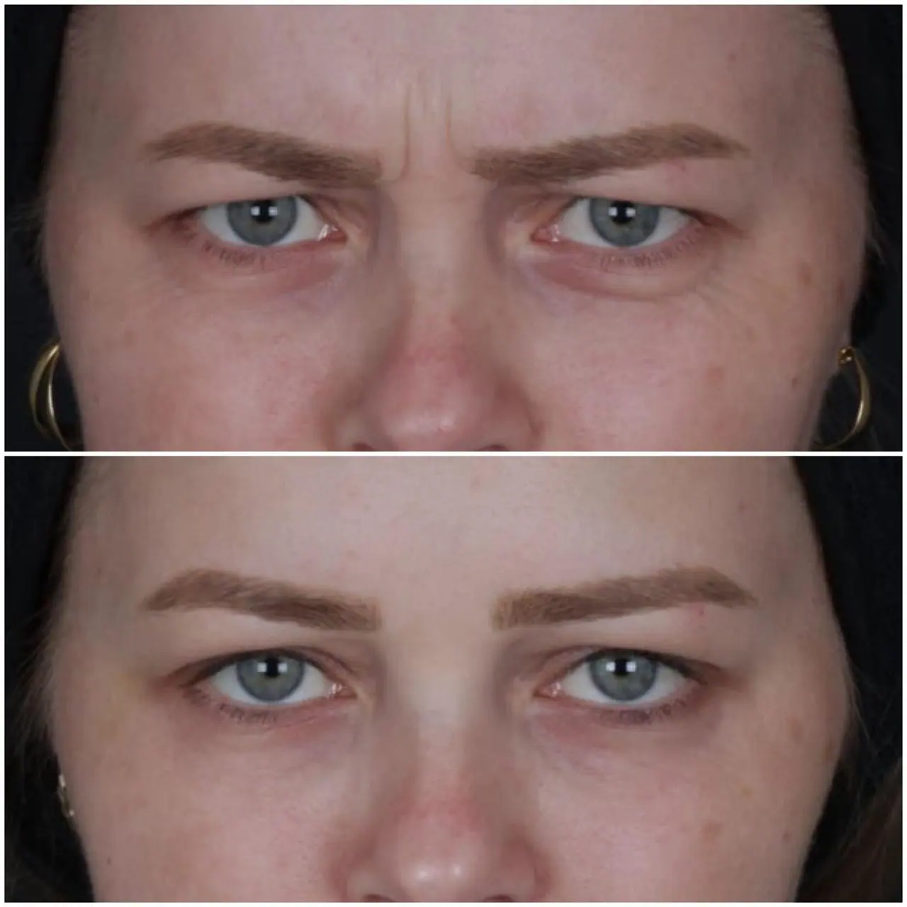 Botox - Glabela