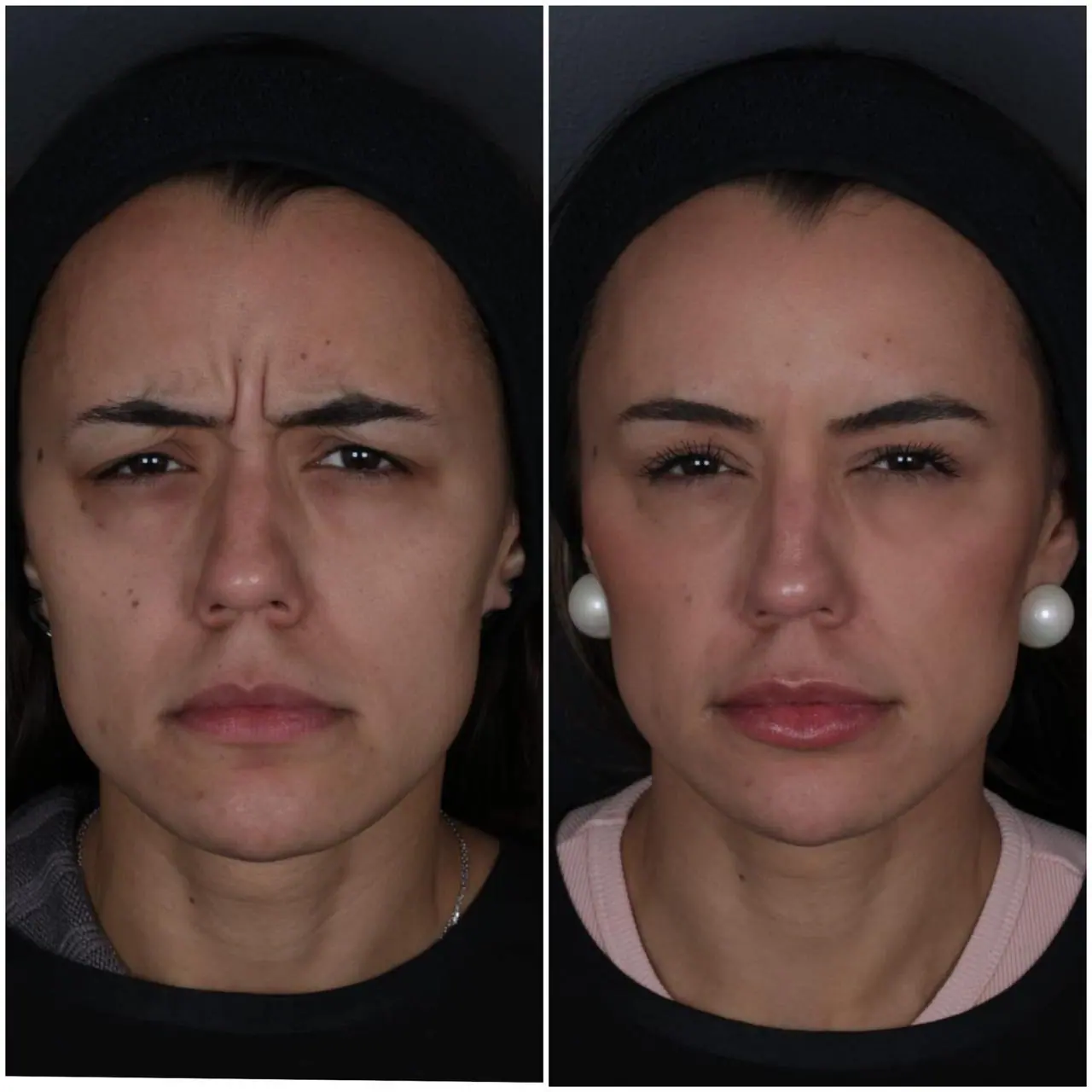 Harmonização Facial Completa