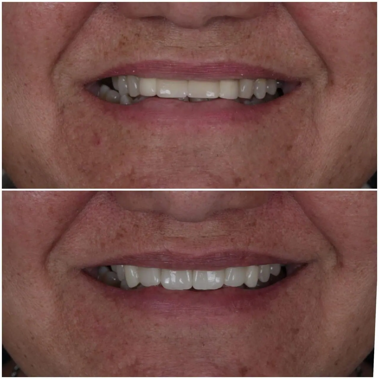 Prótese Dentária