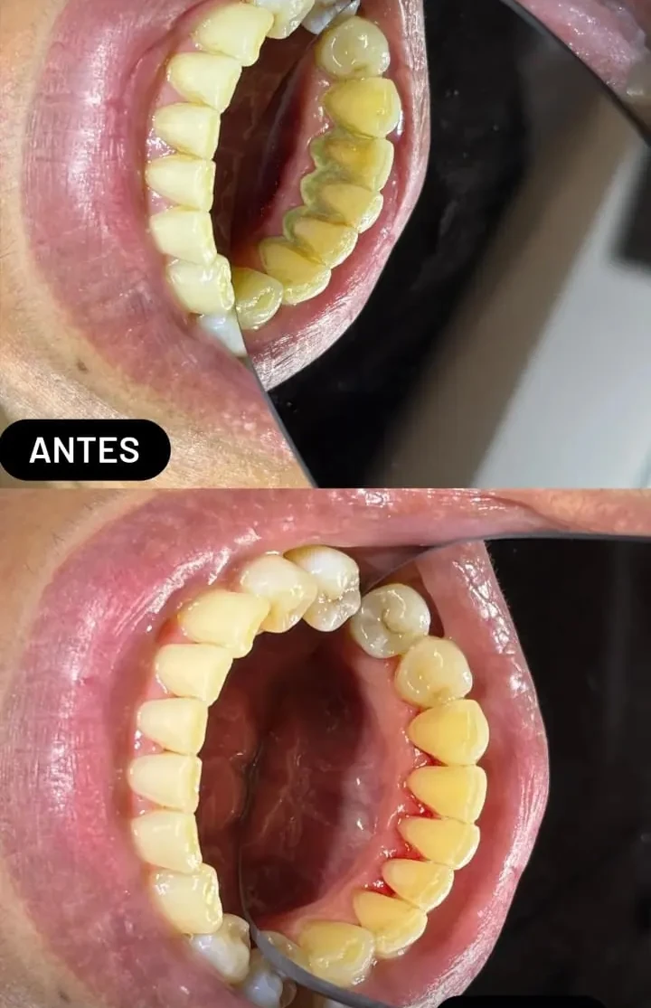 Limpeza Dental - Antes e Depois