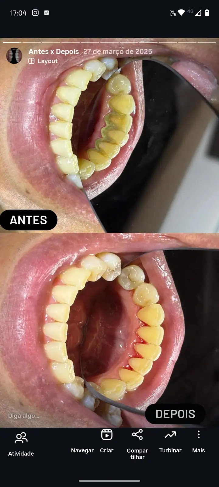 Limpeza Dental - Antes e Depois