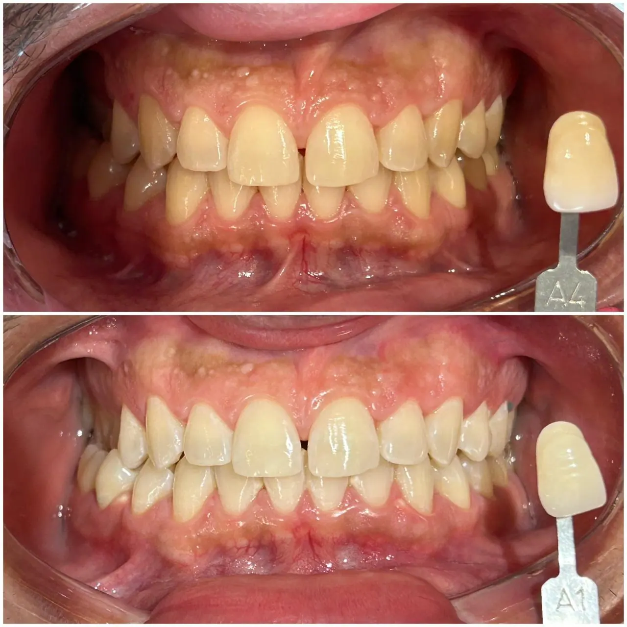 Clareamento Dental