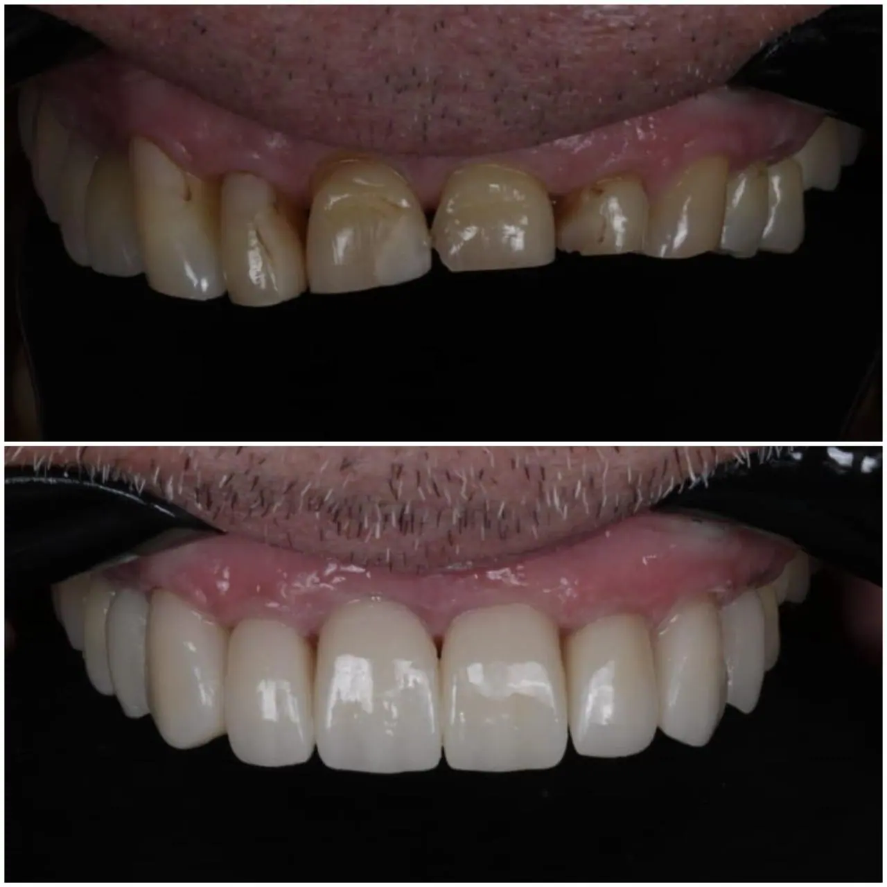 Lentes de Contato Dental