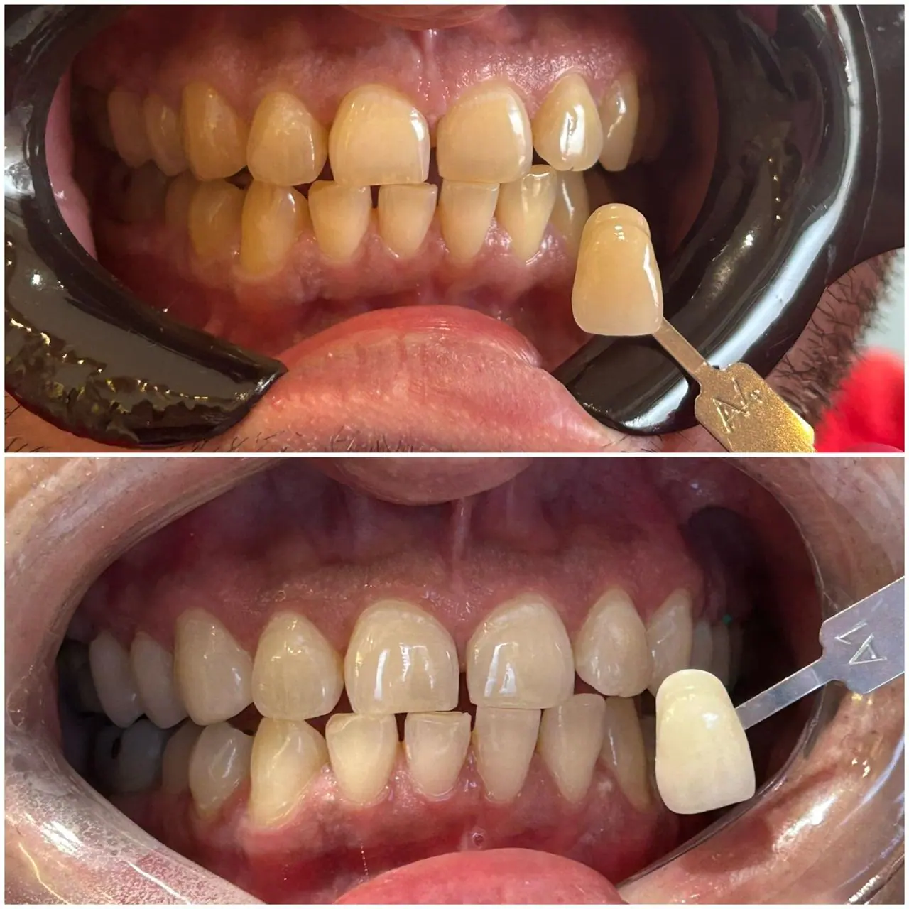 Clareamento Dental