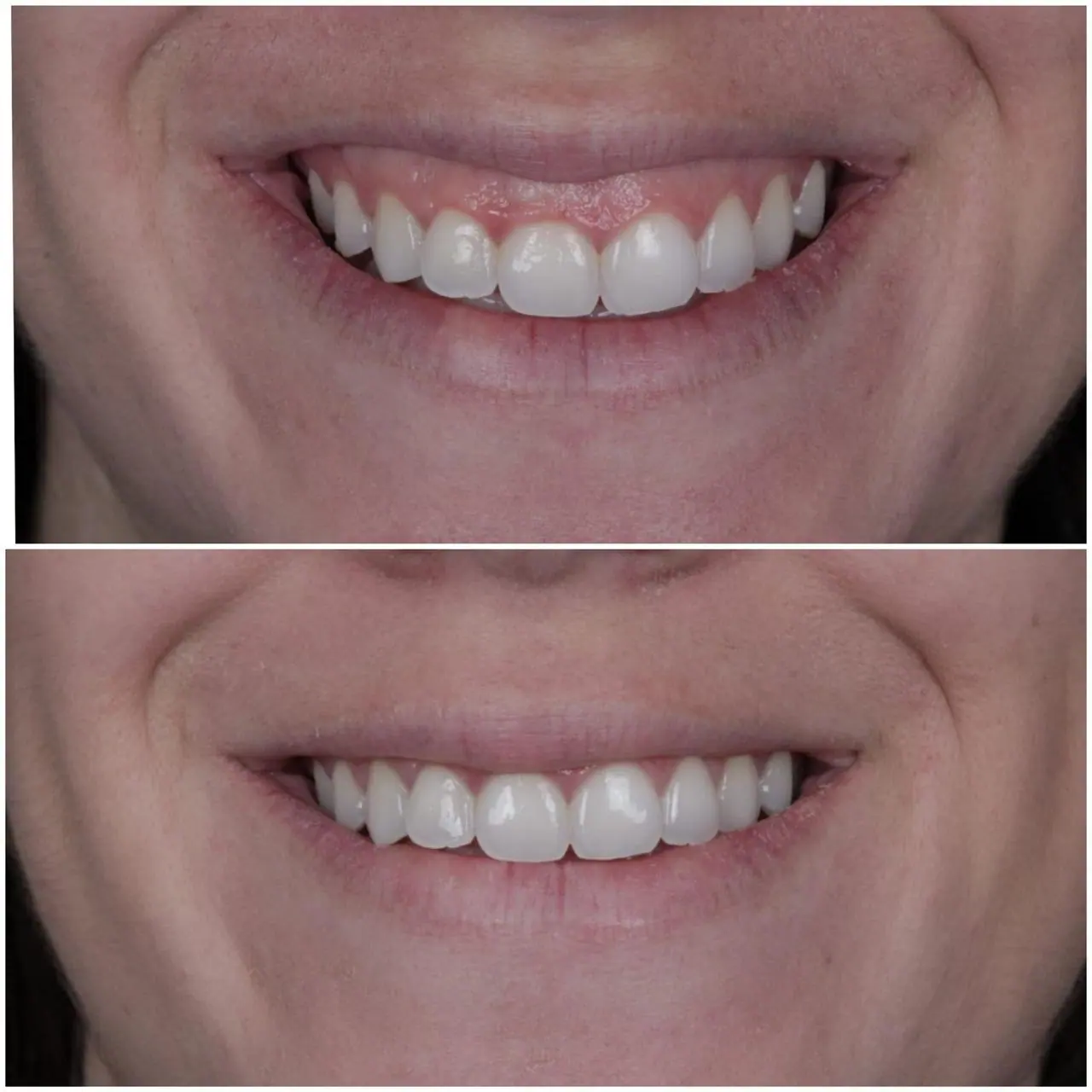 Botox Para Sorriso Gengival