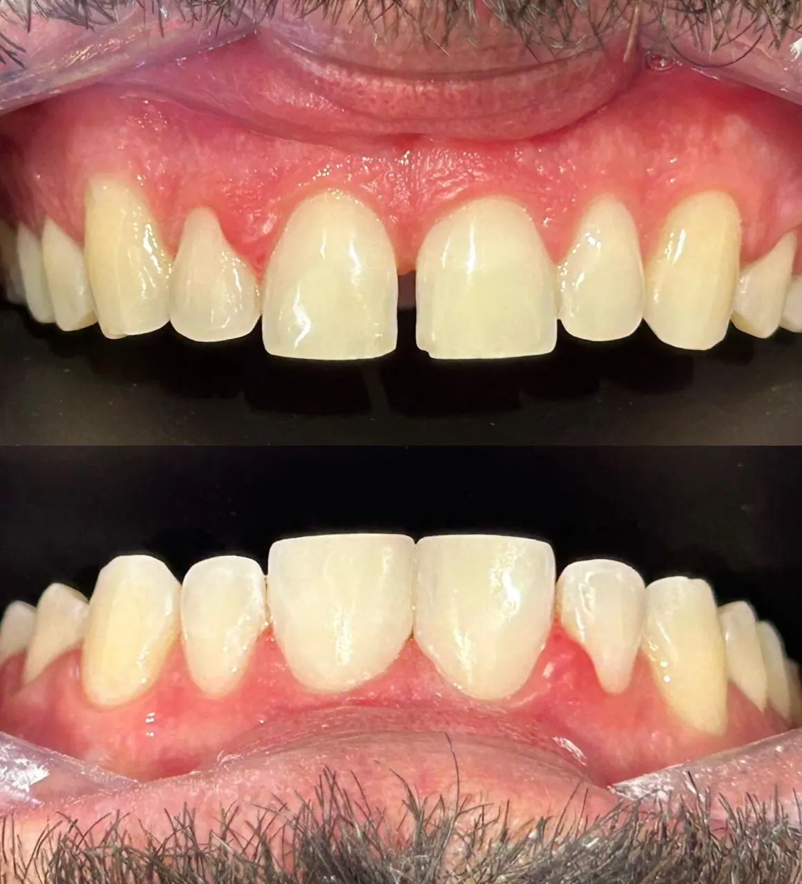 Fechamento de Diastema